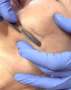 dermaplan